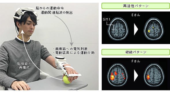 BMIによる脳の神経回路再生への取り組み