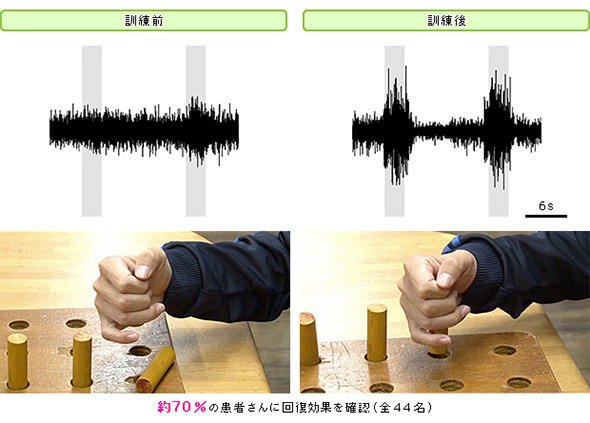 ものをつかむ機能の回復の様子